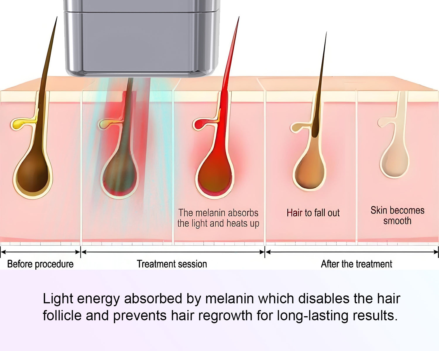 How RaysDanc IPL laser hair
removal device work,Intense pulsed light work
