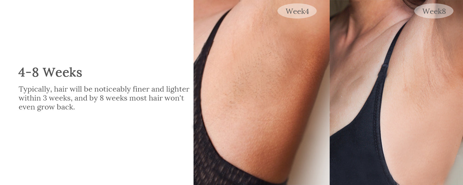 raysdanc ipl laser hair removal results before and after, underarm hair removal, permanent hair removal