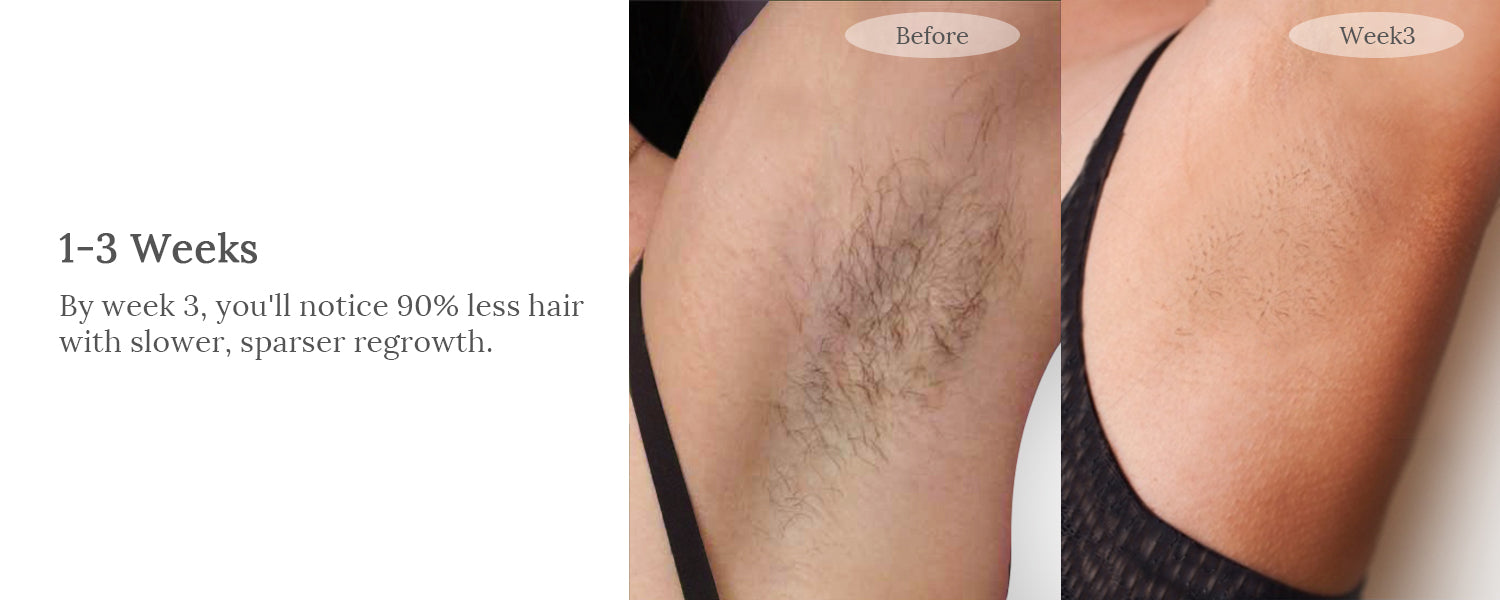raysdanc ipl laser hair removal results, ipl laser hair removal before and after underarm hair removal
