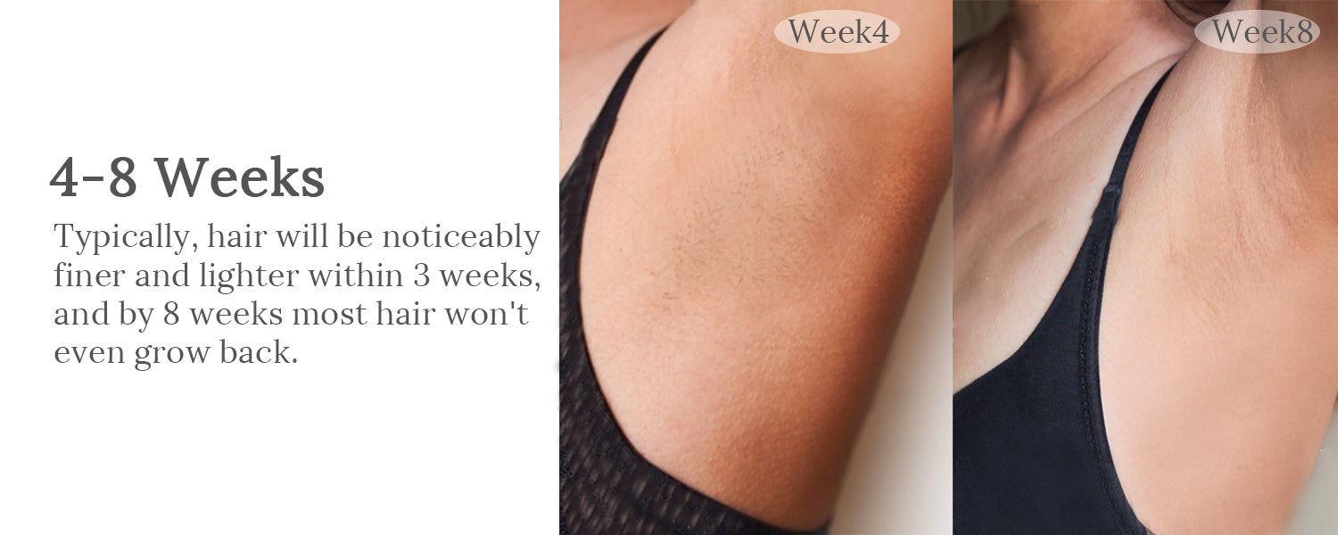 raysdanc ipl laser hair removal results, ipl laser hair removal before and after underarm hair removal